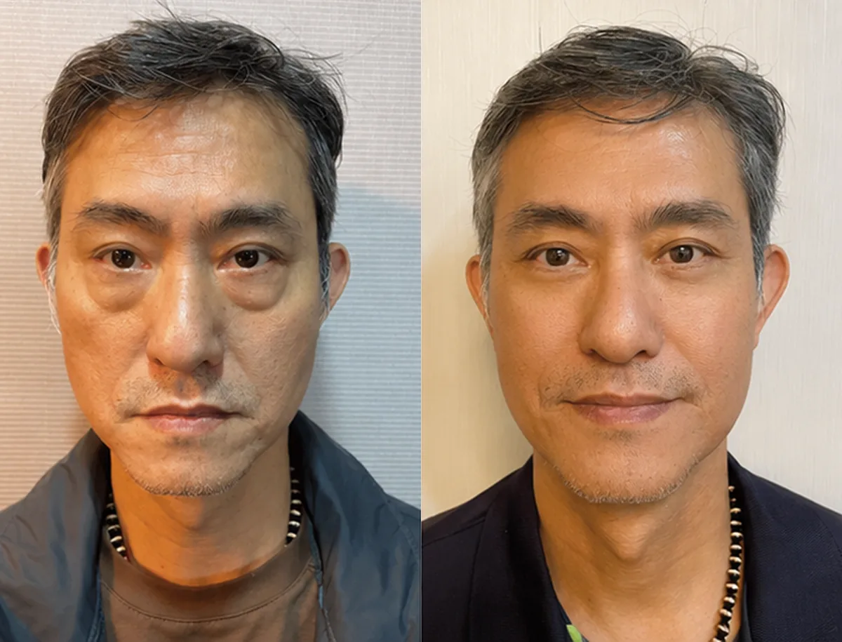 電頻眼袋術前術後對比 4