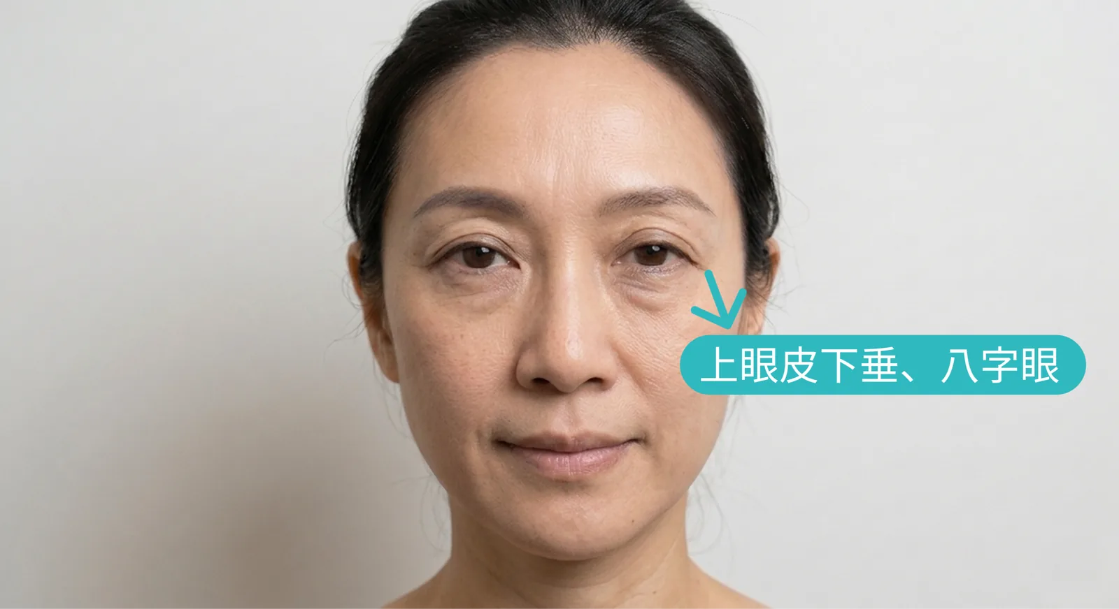 眉下切上眼皮拉提
