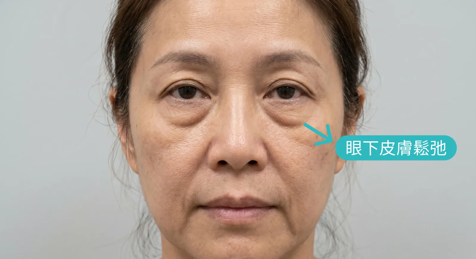 眼下修皮筋膜拉提