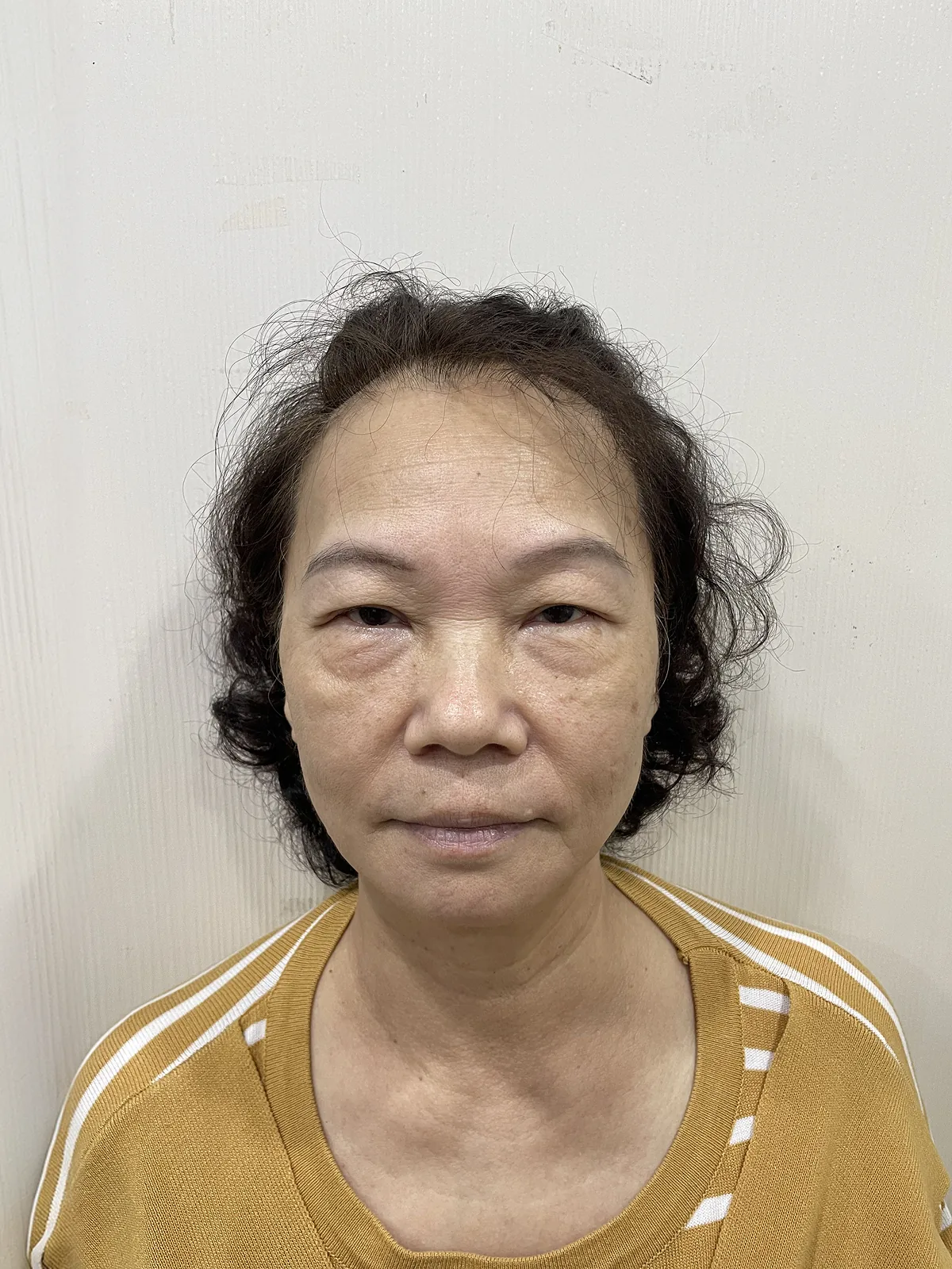 術前
