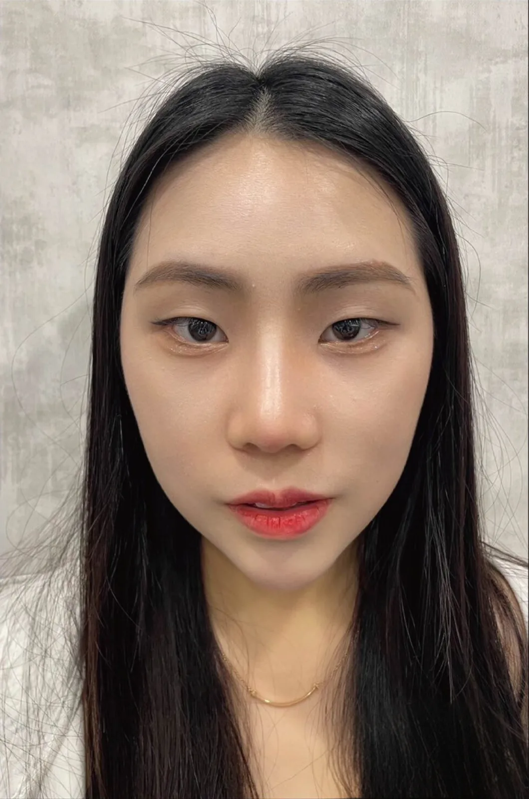 術後正面照片
