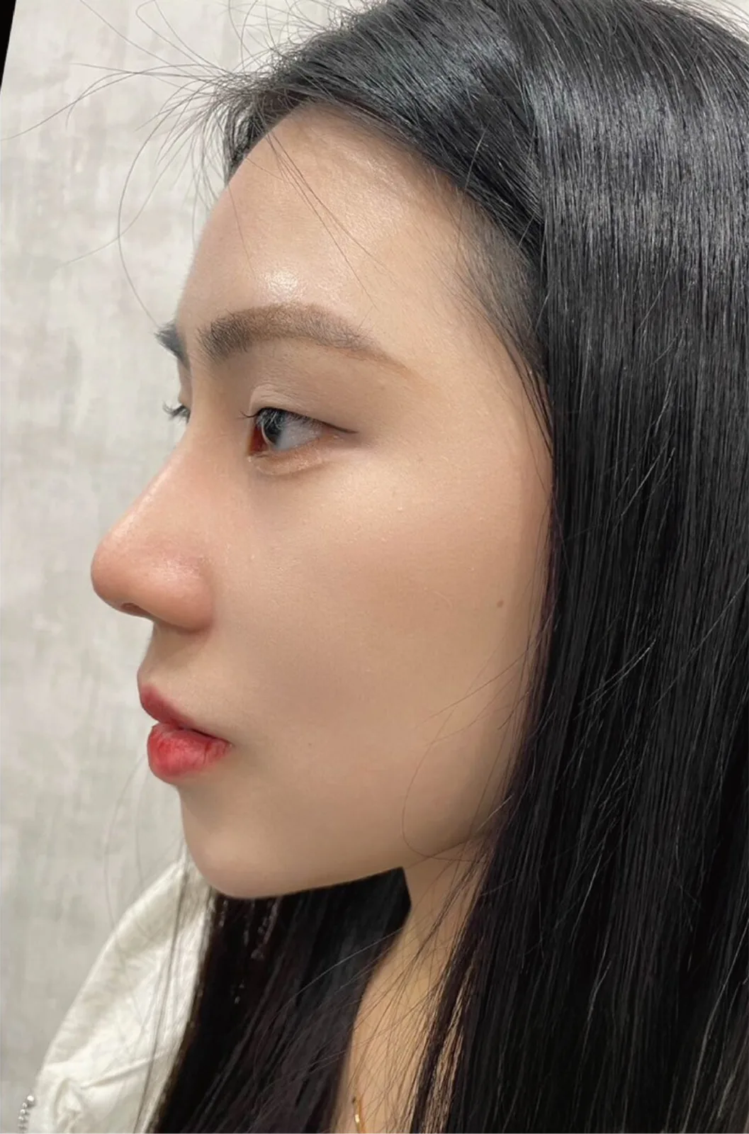 術後