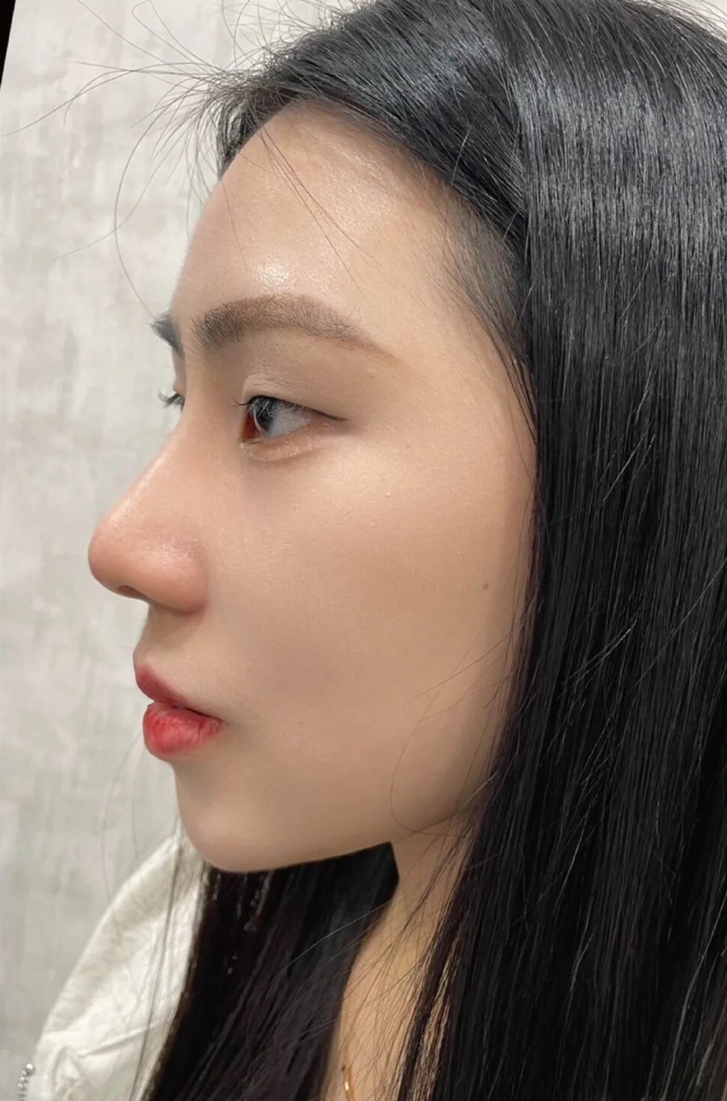 術後