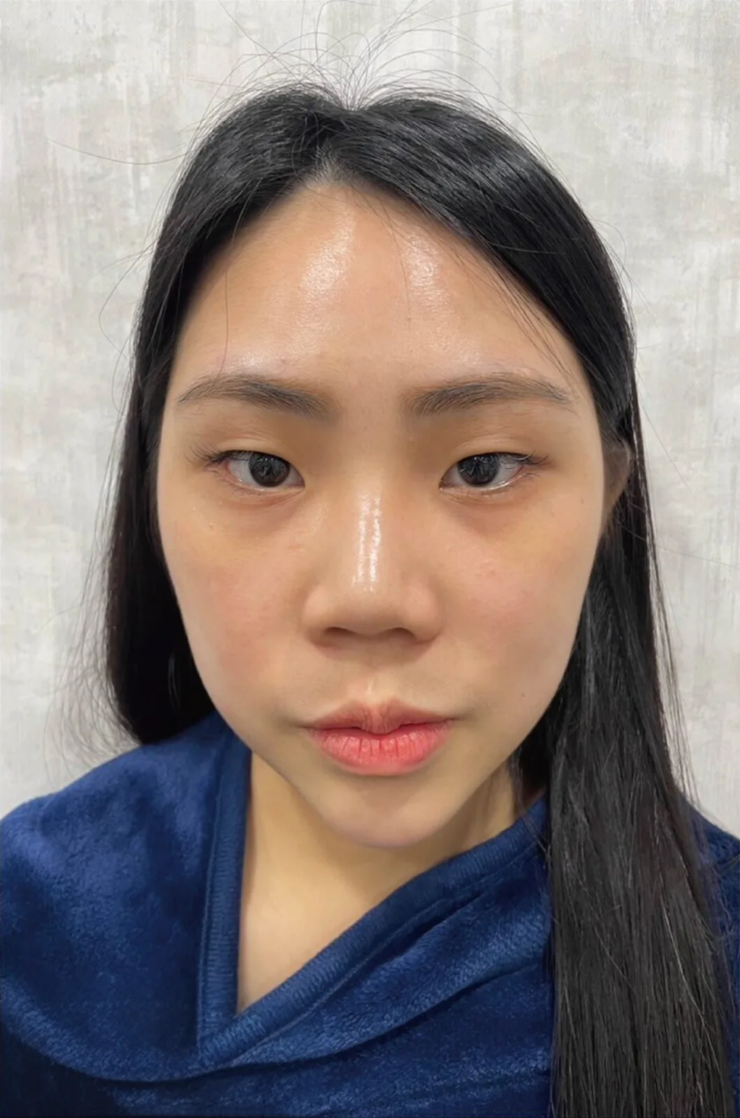 術前正面照片