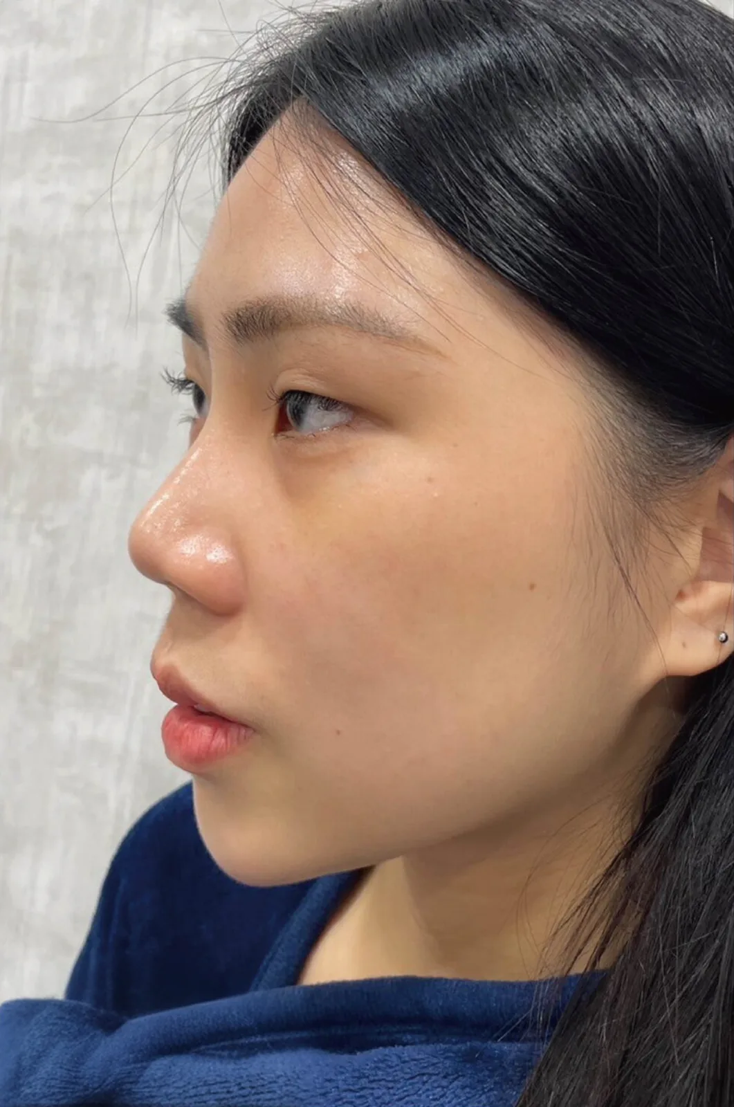術前