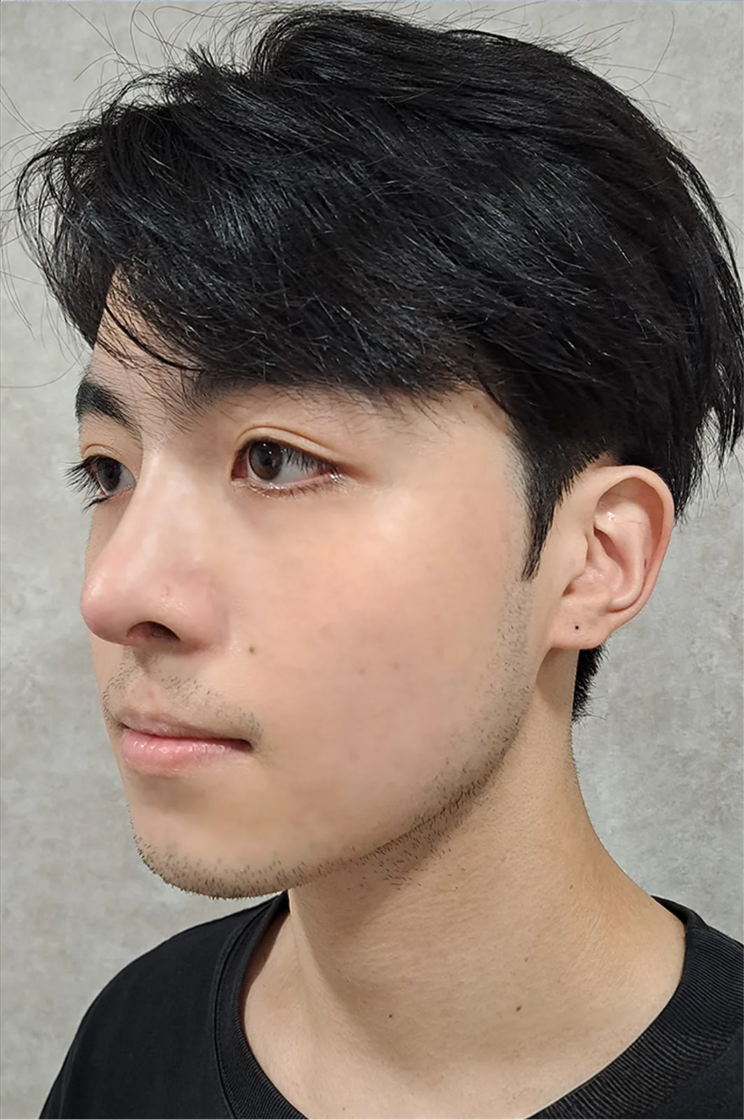 術後