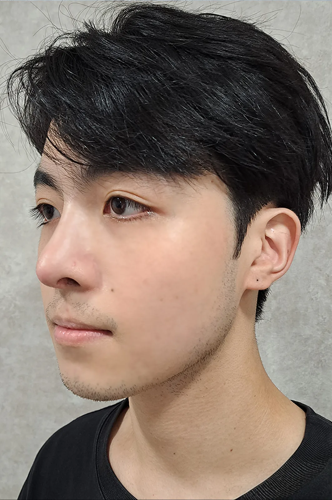 術後