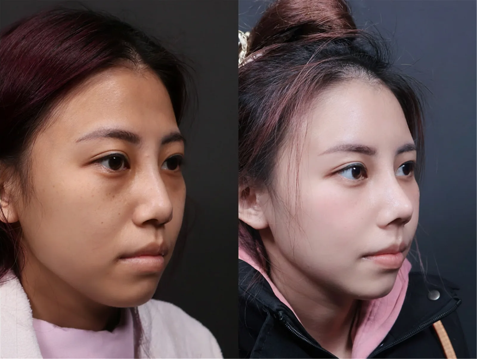 鼻整形術前術後對比 4