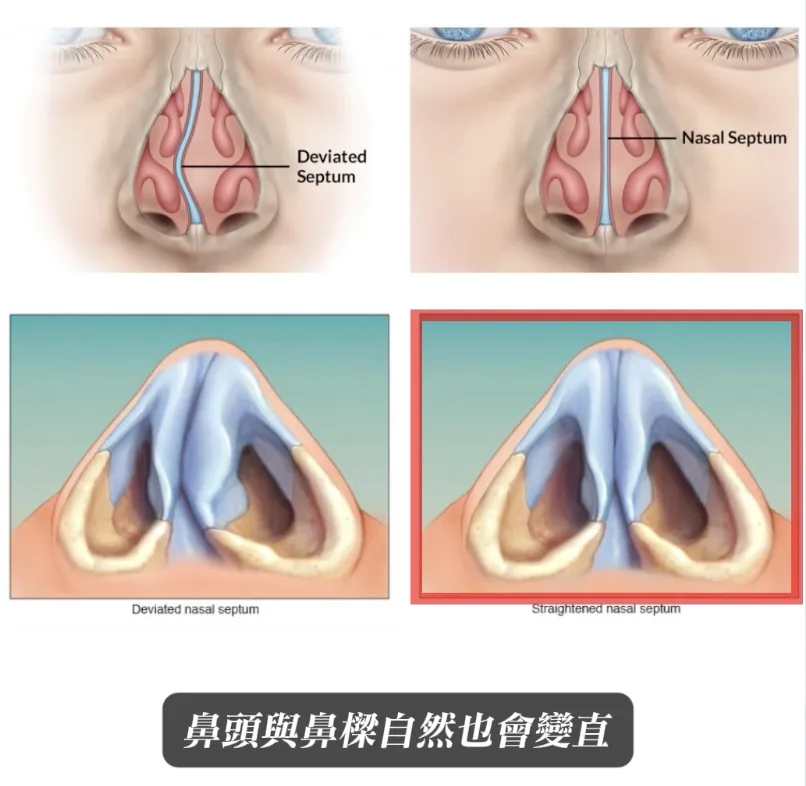 鼻中隔示意